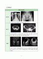 [성인간호학 A＋] 양측 서혜부 탈장(Bilateral inguinal hernia) 간호과정 case study 8페이지