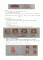 결장 직장암의 치료와 간호(1. 치료 2. 간호 3. 간호진단) 4페이지