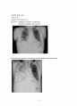 pleural effusion 흉막삼출증 케이스, 흉수 케이스, 흉막삼출증 간호과정, pleural effusion 케이스, 흉막삼출증 사례연구 5페이지