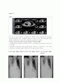 pleural effusion 흉막삼출증 케이스, 흉수 케이스, 흉막삼출증 간호과정, pleural effusion 케이스, 흉막삼출증 사례연구 6페이지