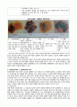 간호, case study, 성인, 악성 흑색종 (malignant melanoma) 3페이지