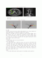 A+ Cerebral infarction 뇌경색 케이스 스터디(Cerebral infarction, 뇌경색 케이스 스터디, 뇌경색 간호과정, 뇌경색 간호진단, 뇌졸중 케이스, 뇌졸중 간호과정) 5페이지