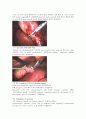 수술실 CASE STUDY : Laparoscopic cholecystectomy (복강경 담낭절제술) 4페이지