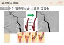 뇌경색의 치료와 간호 ppt 13페이지