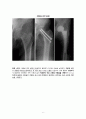 대퇴골 경부 골절 케이스 fracture of neck of femur, part unspecified, closed 간호과정 8페이지