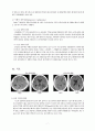 A+ SDH 경막하 출혈 케이스 스터디 6페이지