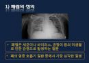 폐렴 / 폐렴 ppt / pneumonia 10페이지