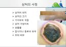 [상처관리-욕창, 수] 상처관리-욕창,  수술창상,  화상 16페이지