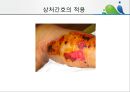 [상처관리-욕창, 수] 상처관리-욕창,  수술창상,  화상 28페이지