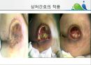 [상처관리-욕창, 수] 상처관리-욕창,  수술창상,  화상 29페이지