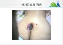 [상처관리-욕창, 수] 상처관리-욕창,  수술창상,  화상 30페이지