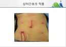 [상처관리-욕창, 수] 상처관리-욕창,  수술창상,  화상 34페이지