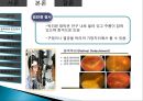 망막장애 대상자 병태생리, 간호 9페이지