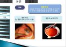 망막장애 대상자 병태생리, 간호 11페이지