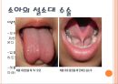 설소대 수술에 관한 ppt 입니다 6페이지