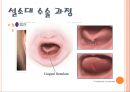 설소대 수술에 관한 ppt 입니다 7페이지