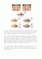 [수술실 실습] septoplasty(비중격 성형술) 케이스 6페이지