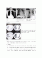 급성호흡곤란증후군 (Acute Respiratory Distress Syndrome) 8페이지
