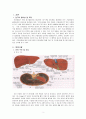 LC & varix bleeding 치료 및 간호 2페이지