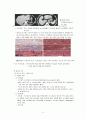 LC & varix bleeding 치료 및 간호 9페이지