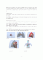 Thymoma(흉선종) 4페이지