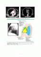 Thymoma(흉선종) 8페이지