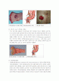 장루간호(수술전,수술후,종류) 7페이지