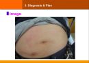 case발표 내과(SJS) 17페이지