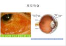 눈건강장애 2페이지