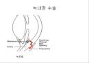 눈건강장애 12페이지
