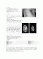 [동서협진과 CASE] 급성뇌경색으로 입원하였으나 폐렴으로 인한 증상이 호전  재발을  2페이지
