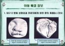 구개열 아동 치료 -사례 발표- 4페이지