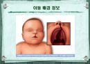 구개열 아동 치료 -사례 발표- 5페이지