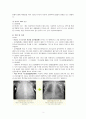 신생아 중환자실 (NICU) 사례보고서 호흡곤란증후군(RDS)문헌고찰간호과정 3페이지