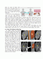 성인간호학 실습case studyHCC with bone meta간암문헌고찰간호진단 3개간호중재이론적근거MMSE일상생활수행도구낙상사정평가욕창사정평가 등 9페이지