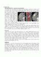성인간호학 실습case studyHCC with bone meta간암문헌고찰간호진단 3개간호중재이론적근거MMSE일상생활수행도구낙상사정평가욕창사정평가 등 10페이지