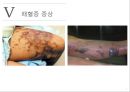 패혈증에 대한 ppt 발표자료 A++ 폐혈증 Sepsis 정의 원인 증상 합병증 치료 간호 A++.ppt 6페이지