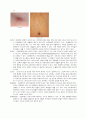 [성인간호학] 성인 간경화증 - 간경변증(liver cirrhosis, LC) 3페이지