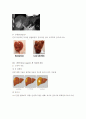 간암 케이스 스터디 (Liver Cancer) 8페이지