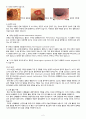 직장구불결장 이행부 암 케이스 스터디 ( 직장암 케이스 결장암 케이스 Rectosigmoid junction cancer 간호과정 4개) 4페이지