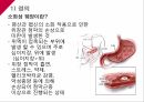 A+소화성궤양 4페이지