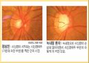 녹내장ppt 4페이지