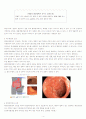 Ulcerative Colitis(궤양성대장염) 성인간호학 A+ Case Study 자료 4페이지