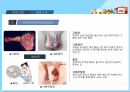 아동간호학 - 잠복고환 조별과제 ppt 6페이지