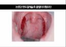 a+++ 수술간호 ppt 편도절제술 1. 편도란? 2. 적응증 3. 검사/시술/수술 방법 4. 준비사항 5. 경과 및 합병증 6. 수술 전 간호 7. 수술 후 간호 8. 참고문헌 9. 느낀점 13페이지