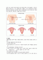 case study 제왕절개 4페이지