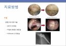 어깨충돌증후군 12페이지