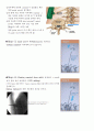 Kyphoplasty(경피적 풍선 척추 성형술) 7페이지