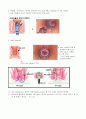 Hemorrhoidectomy-PPH수술 5페이지
