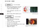 [발표 PPT/4.5(A+) 자료] 백내장(cataract) 29페이지